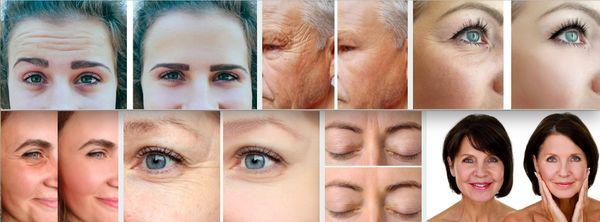 Our Botox treatment priced at $400 covers frown lines, crow's feet, and forehead. Free consultation. No extra charges.