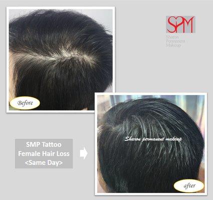 Female Hair Loss - Scalp Tattoo, Scalp Micropigmentation (SMP)