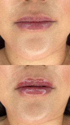 Before and after 1ml needle-less lip filler