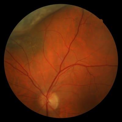 Image of tumor in the eye