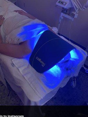 Getting the Celluma LED therapy acne treatment