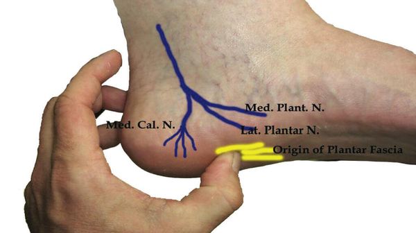 Baxter's Nerve Entrapment 2