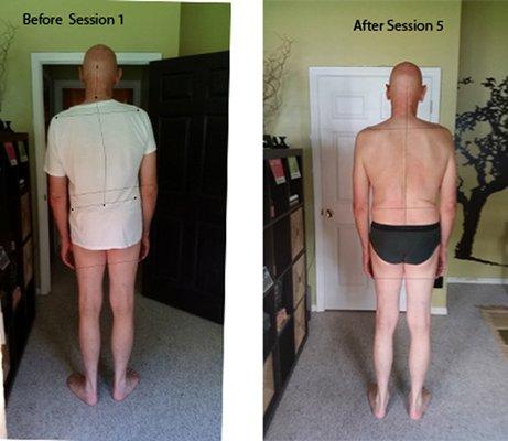 Photos showed a before and after body posture after 5 Rolfing sessions.