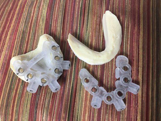 Layered Surgical Guides aid in bone reduction and implant placement