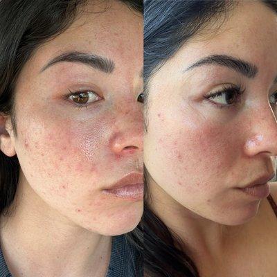 Taken almost a month apart. Day of my chemical peel just prior and 4 weeks later.