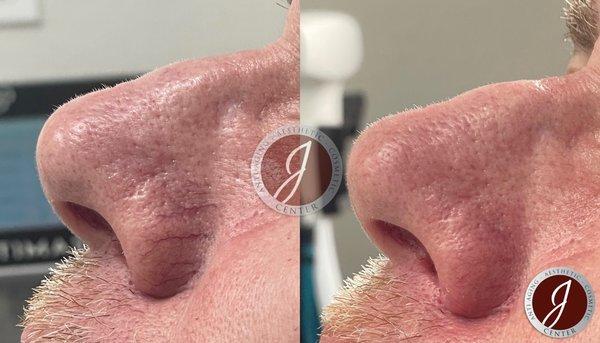 V-laze Treatment done on Veins near nose