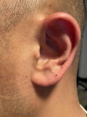 Picture of my left ear where my infection was