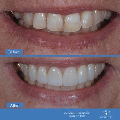 Before & After Smile Makeover