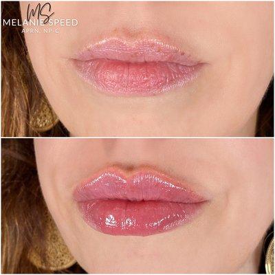 Before and after lip augmentation by Melanie Speed, NP-C