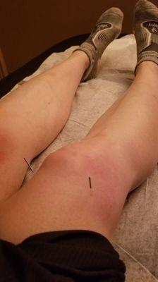 Acupuncture After Acupressure