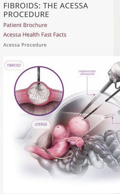 Only in South Florida offering Acessa Procedure