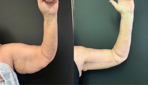 Vaser Liposuction full arms w/ brachioplasty extending down to the wrists.  19 weeks post op.