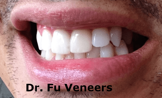 Veneers by Fu