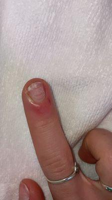 Infected finger nail