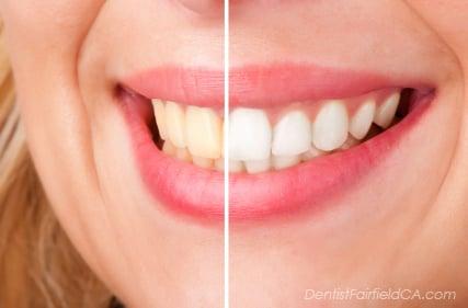 Brighten Up Your Smile at Mark J. Warner DDS Inc.