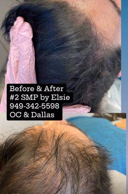 Density SMP for Male, 60s -4.15 hours. Will need 2-4 sessions for results like this. Results varies for each scalp is unique