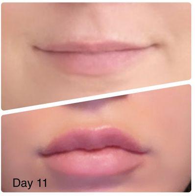 Lips before procedure (top photo) and lips on day 11 after 1 syringe of Juvèderm Ultra Plus.