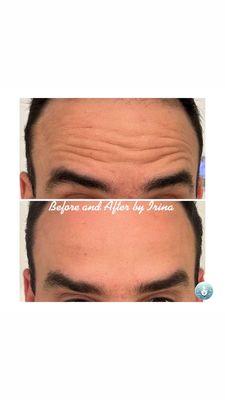 Relaxing wrinkles with Botox or Dysport