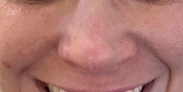 Nose 14 months after paying for a rhinoplasty and septoplasty.