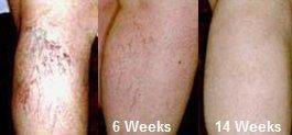 Vericose veins treatment.