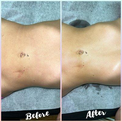 Body contouring/sculpting