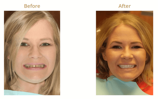 All-on-4® Implant Dentures helped this patient regain her smile