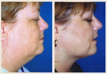 Neck liposuction