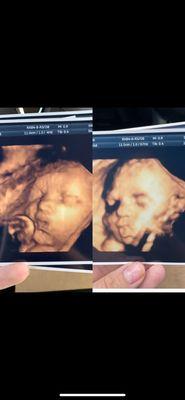 Baby #1 and baby #2, 2.5 years apart both at sneak a peek