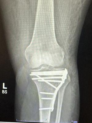 X ray after surgery