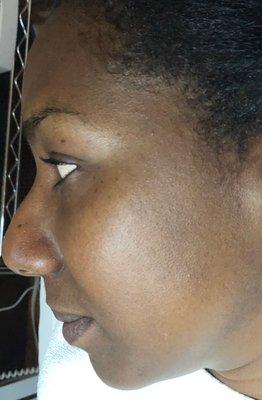 Before Dermaplaning.