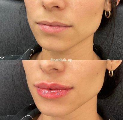 Lip Filler