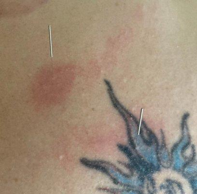 My upper back/shoulder blade shows much redder/purple than picture. This is inflammation release.