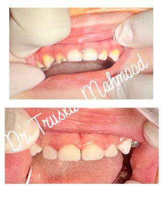 White crowns to restore decayed front baby teeth.