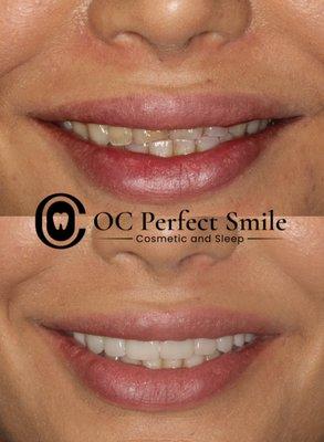 8 natural veneers.