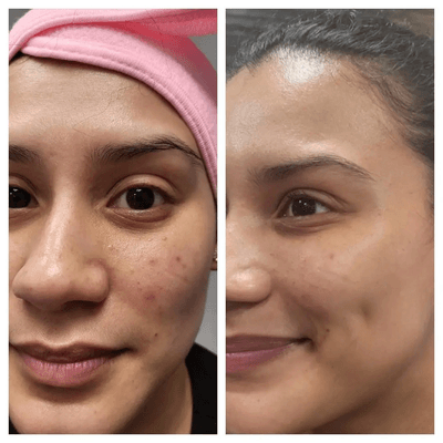 Kinetic Microderm before and after.