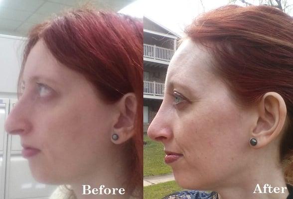 Left profile, before surgery & two weeks after