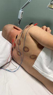 arranged electric acupuncture treatment.