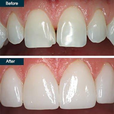 chipped tooth and repaired tooth with bonding.