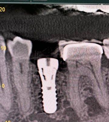 Tooth #20 implant placed with perfection by Dr.Aldujaili