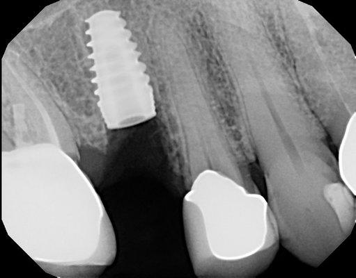 Implant restoration