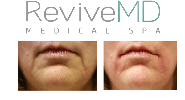 1 CC Juvederm Ultra XC to Marionette.  Excellent results with same day picture taken.