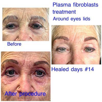 Plasma fibroblasts eyes lids treatment... before & after at Gianna's beauty salon...