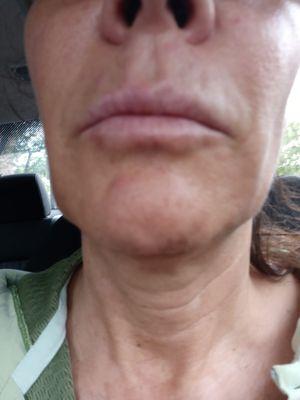 downturned mouth. lines above mouth and chin and jaw. wrinkles under chin all new and worse.