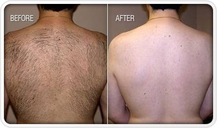 back wax before/after