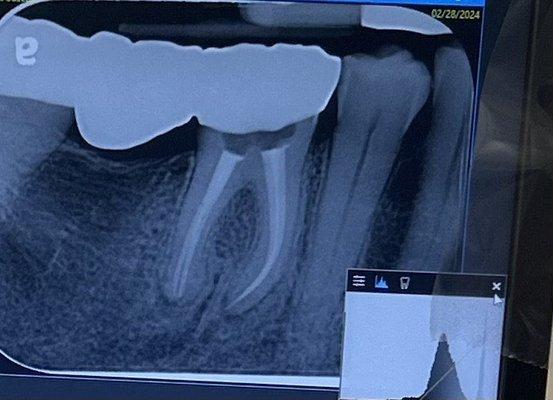 Root canal tissue /pulp cavity