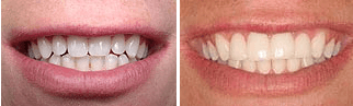 a reshaped smile using CEREC technology