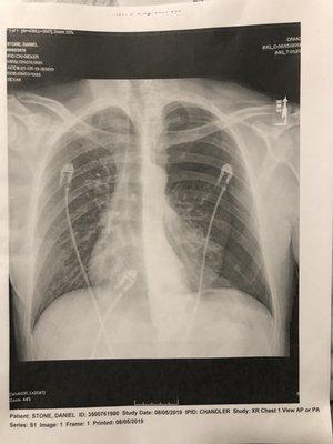 X-ray done in Phoenix showing a left side Pneumothorax