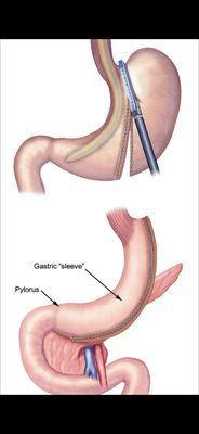 Laparoscopic Vertical Sleeve Gastrectomy