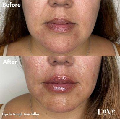 Treated her Smile Lines & Added volume to her lips - Injected by PA Donell