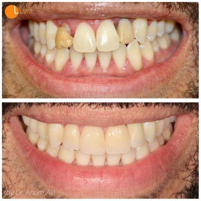 Conservative dentistry at  its best: life-altering smile makeover, working on only 4 teeth! Lumia Dental also provides whitening, Invisalign